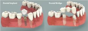 dental implant vs bridge