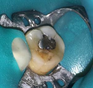 amalgam filling removal