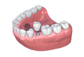 single tooth implant