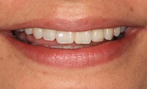 smile makeover