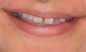 smile makeover