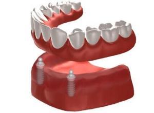 dental implant over denture