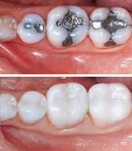 When should a tooth filling be replaced?