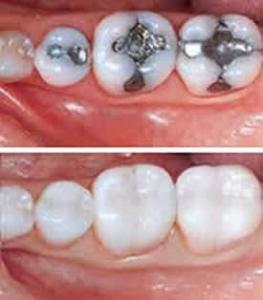 Do Fillings Need to be Replaced? Here's What You Need to Know