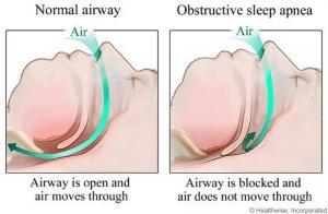 sleep apnea dentist rockville