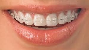 kids braces orthodontist