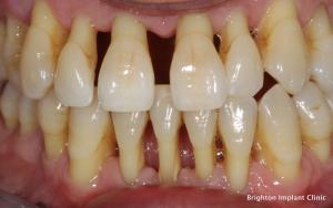 what-causes-periodontal-disease