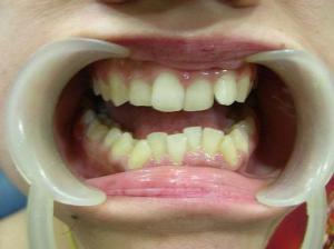 braces orthodontics