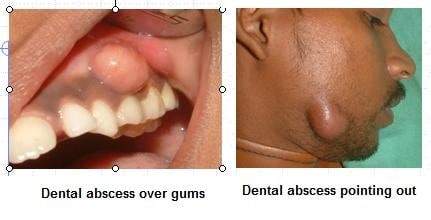 root canal negative reviews