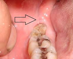 extraction gums clot extractions dentist