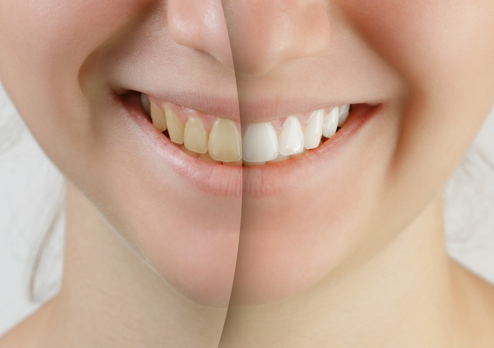 a woman's smile before and after whitening.